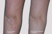 画像をギャラリービューアに読み込む, Dermahealer Psoriasis Elbow Treatment Results